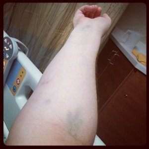 Right arm bruises and left was matching.